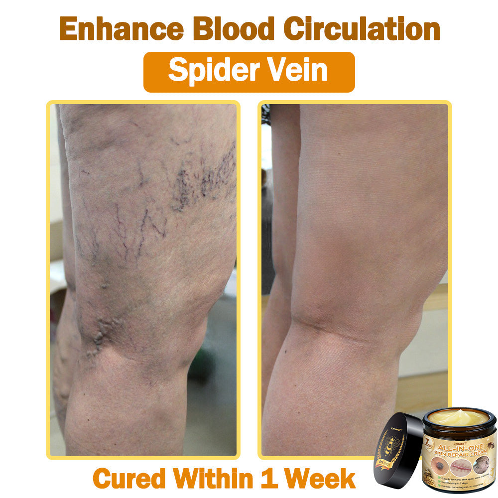 [𝐎𝐟𝐟𝐢𝐜𝐢𝐚𝐥 𝐁𝐫𝐚𝐧𝐝 𝐒𝐭𝐨𝐫𝐞]👑 𝐋𝐞𝐧𝐚𝐫𝐨™ 𝐁𝐞𝐞 𝐕𝐞𝐧𝐨𝐦 𝐀𝐥𝐥-𝐢𝐧-𝐎𝐧𝐞 𝐂𝐫𝐞𝐚𝐦 𝐀𝐩𝐩𝐫𝐨𝐯𝐞𝐝 𝐛𝐲 𝐒𝐨𝐮𝐭𝐡 𝐀𝐟𝐫𝐢𝐜𝐚𝐧 𝐝𝐞𝐫𝐦𝐚𝐭𝐨𝐥𝐨𝐠𝐢𝐬𝐭𝐬 👩‍⚕️ (𝐒𝐩𝐞𝐜𝐢𝐚𝐥𝐥𝐲 𝐫𝐞𝐜𝐨𝐦𝐦𝐞𝐧𝐝𝐞𝐝 𝐛𝐲 𝐭𝐡𝐞 𝐒𝐨𝐮𝐭𝐡 𝐀𝐟𝐫𝐢𝐜𝐚𝐧 𝐀𝐜𝐚𝐝𝐞𝐦𝐲 𝐨𝐟 𝐃𝐞𝐫𝐦𝐚𝐭𝐨𝐥𝐨𝐠𝐲 𝐢𝐧 𝟐𝟎𝟐𝟓)