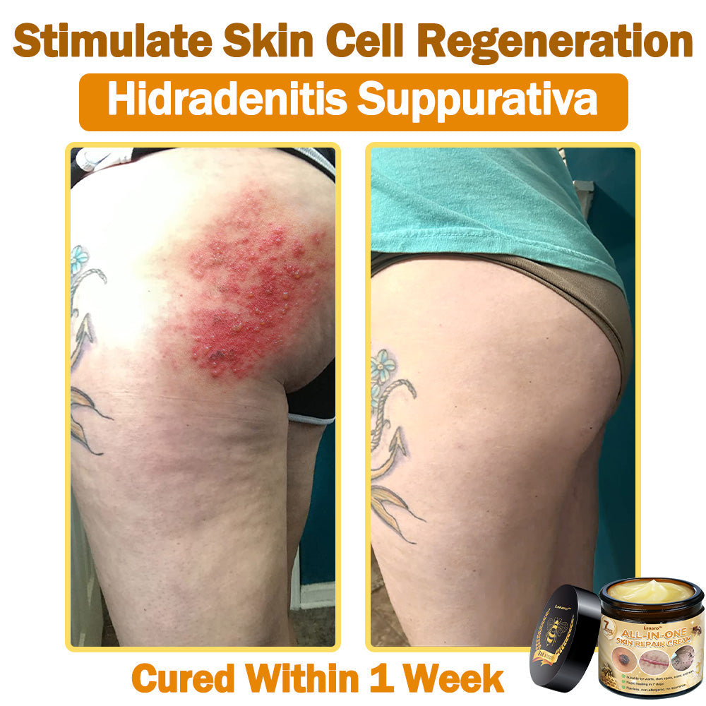 [𝐎𝐟𝐟𝐢𝐜𝐢𝐚𝐥 𝐁𝐫𝐚𝐧𝐝 𝐒𝐭𝐨𝐫𝐞]👑 𝐋𝐞𝐧𝐚𝐫𝐨™ 𝐁𝐞𝐞 𝐕𝐞𝐧𝐨𝐦 𝐀𝐥𝐥-𝐢𝐧-𝐎𝐧𝐞 𝐂𝐫𝐞𝐚𝐦 𝐀𝐩𝐩𝐫𝐨𝐯𝐞𝐝 𝐛𝐲 𝐒𝐨𝐮𝐭𝐡 𝐀𝐟𝐫𝐢𝐜𝐚𝐧 𝐝𝐞𝐫𝐦𝐚𝐭𝐨𝐥𝐨𝐠𝐢𝐬𝐭𝐬 👩‍⚕️ (𝐒𝐩𝐞𝐜𝐢𝐚𝐥𝐥𝐲 𝐫𝐞𝐜𝐨𝐦𝐦𝐞𝐧𝐝𝐞𝐝 𝐛𝐲 𝐭𝐡𝐞 𝐒𝐨𝐮𝐭𝐡 𝐀𝐟𝐫𝐢𝐜𝐚𝐧 𝐀𝐜𝐚𝐝𝐞𝐦𝐲 𝐨𝐟 𝐃𝐞𝐫𝐦𝐚𝐭𝐨𝐥𝐨𝐠𝐲 𝐢𝐧 𝟐𝟎𝟐𝟓)