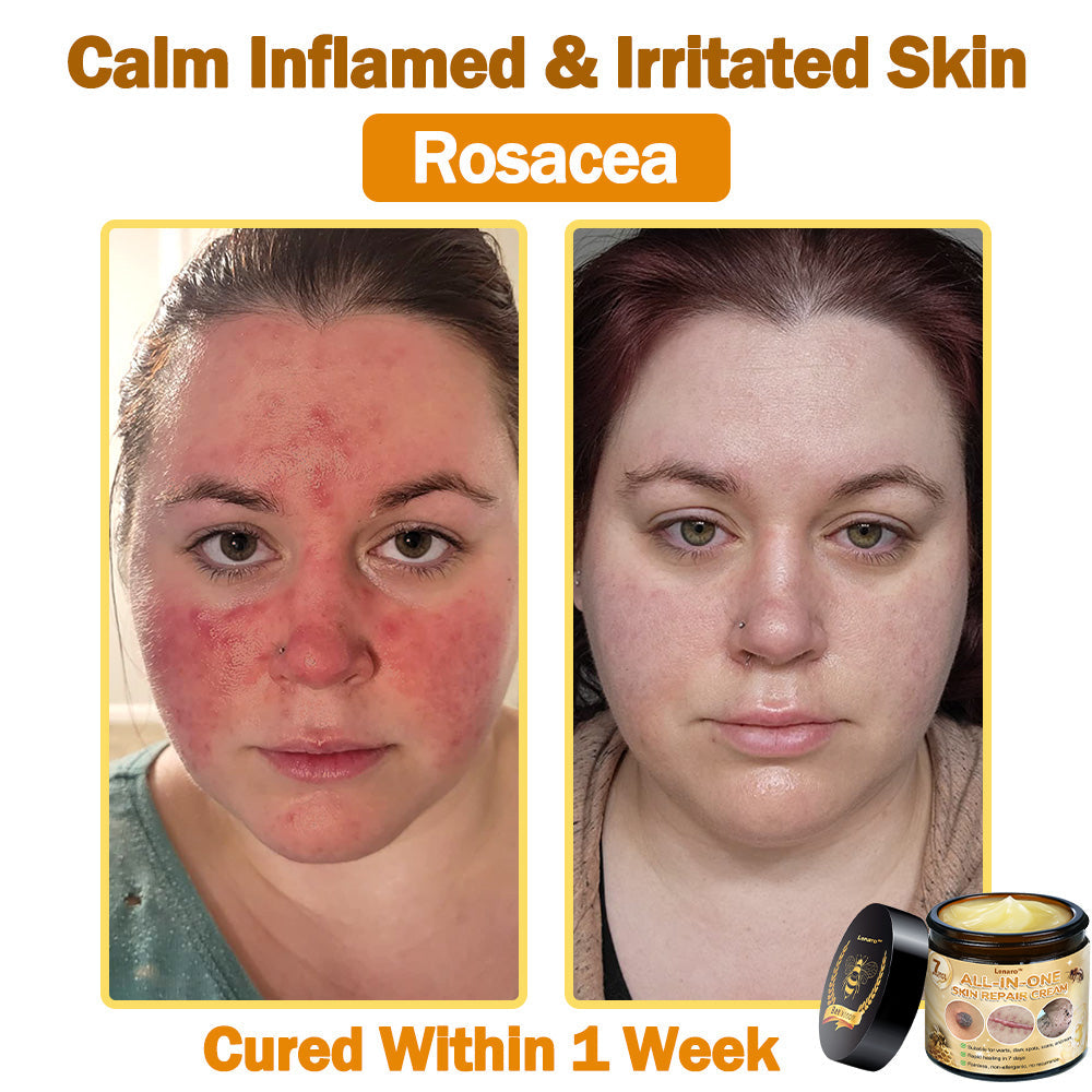 [𝐎𝐟𝐟𝐢𝐜𝐢𝐚𝐥 𝐁𝐫𝐚𝐧𝐝 𝐒𝐭𝐨𝐫𝐞]👑 𝐋𝐞𝐧𝐚𝐫𝐨™ 𝐁𝐞𝐞 𝐕𝐞𝐧𝐨𝐦 𝐀𝐥𝐥-𝐢𝐧-𝐎𝐧𝐞 𝐂𝐫𝐞𝐚𝐦 𝐀𝐩𝐩𝐫𝐨𝐯𝐞𝐝 𝐛𝐲 𝐒𝐨𝐮𝐭𝐡 𝐀𝐟𝐫𝐢𝐜𝐚𝐧 𝐝𝐞𝐫𝐦𝐚𝐭𝐨𝐥𝐨𝐠𝐢𝐬𝐭𝐬 👩‍⚕️ (𝐒𝐩𝐞𝐜𝐢𝐚𝐥𝐥𝐲 𝐫𝐞𝐜𝐨𝐦𝐦𝐞𝐧𝐝𝐞𝐝 𝐛𝐲 𝐭𝐡𝐞 𝐒𝐨𝐮𝐭𝐡 𝐀𝐟𝐫𝐢𝐜𝐚𝐧 𝐀𝐜𝐚𝐝𝐞𝐦𝐲 𝐨𝐟 𝐃𝐞𝐫𝐦𝐚𝐭𝐨𝐥𝐨𝐠𝐲 𝐢𝐧 𝟐𝟎𝟐𝟓)